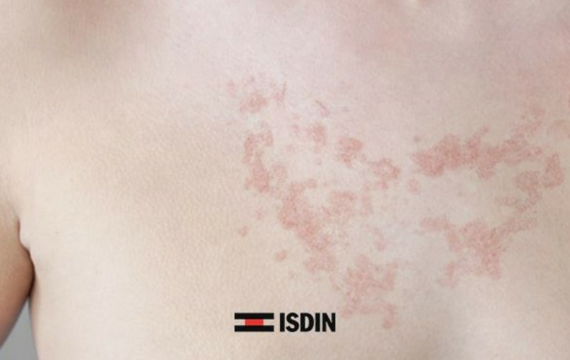 isdin-foto-ultra-solar-allergy-fusion-fluid-spf-100-plus-50-ml-symptomes-allergie-solaire-produit-description-prix-avis-pharmacie-en-ligne-luxembourg-pharmaglobe.lu