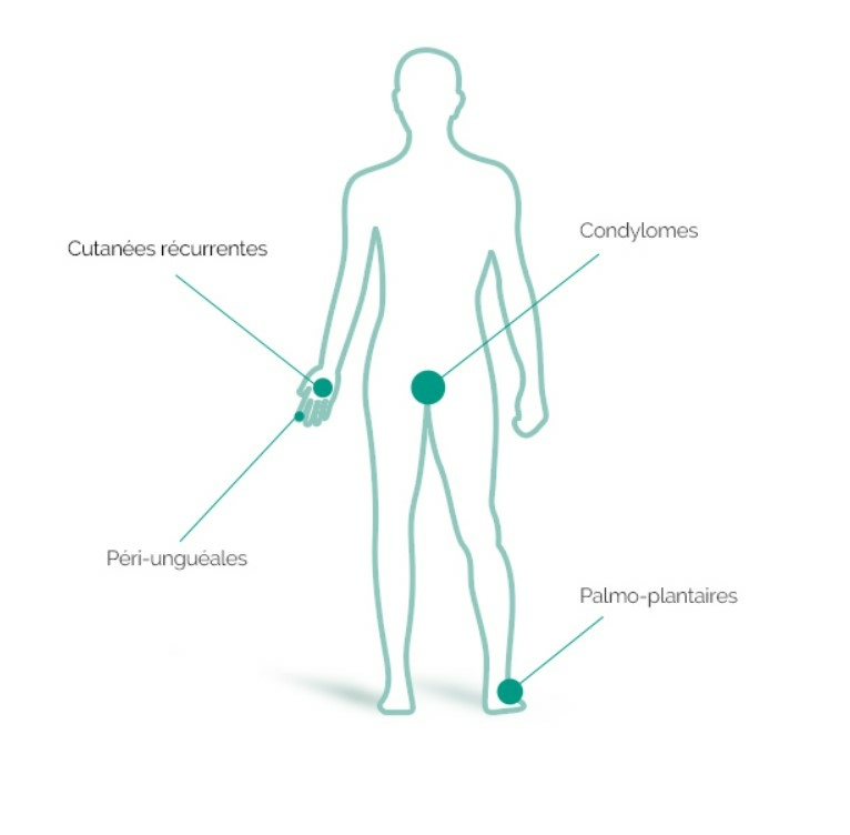 isdin-verrutop-traitement-topique-des-verrues-difficiles-a-traiter-boite-4-ampoules-produit-description-avis-pharmacie-en-ligne-luxembourg-pharmaglobe.lu