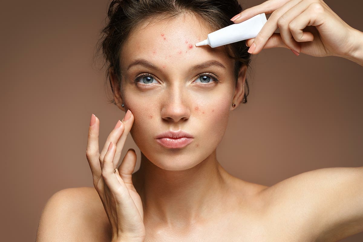 Jeune femme appliquant de la propolis sur l’acné de son visage
