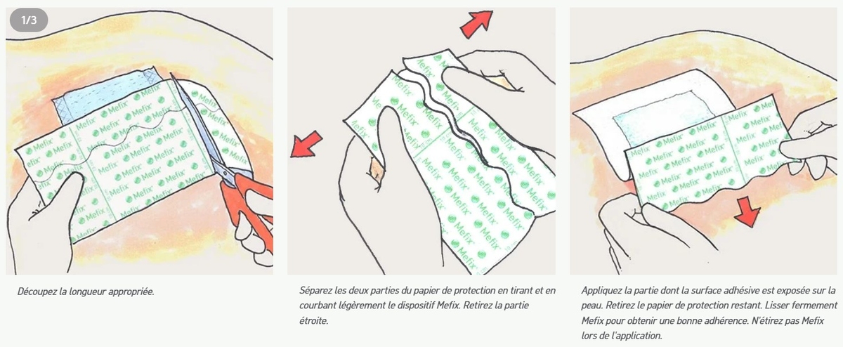 mefix-10cm-x-10m-fixation-adhesive-molnlycke-auto-fixant-utilisation-pharmaglobe.lu