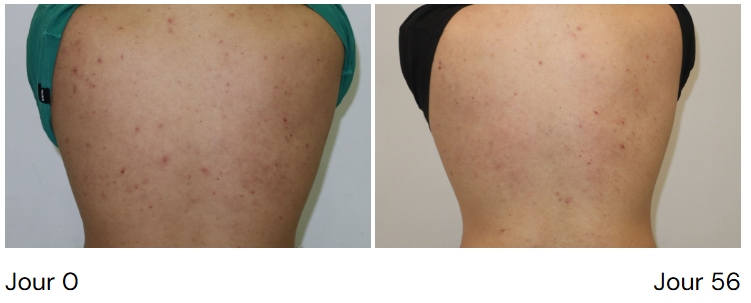 vincobiosis-acneic-spray-lotion-corporelle-corps-forte-pharma-acne-pharmacie-en-ligne-meilleur-prix-luxembourg-kaufen-pharmaglobe